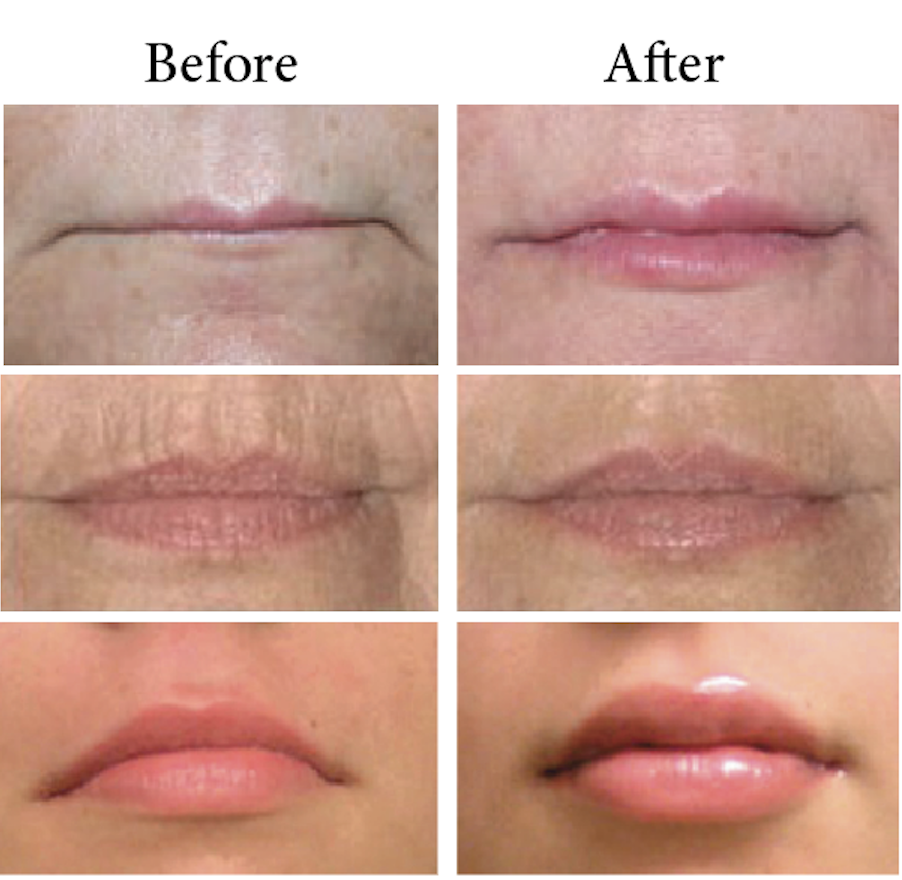 Skinpossible uses Juvederm! Mon to Sat appointments are available!