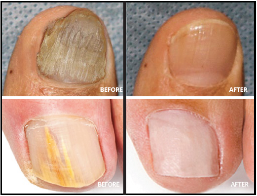 laser-nail0fungus-treatment-calgary