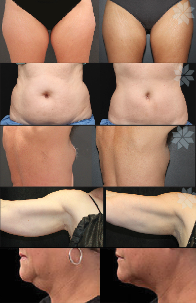 CoolSculpting-real results