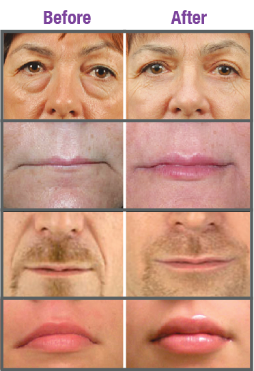 dermal-fillers-injections-calgary