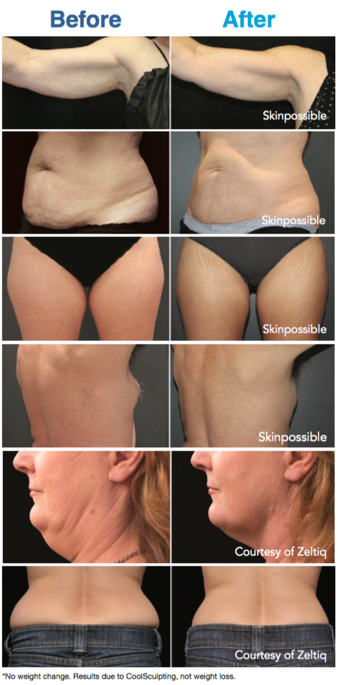 Coolsculpting-skinpossible results