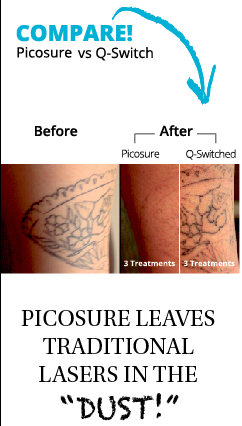 Tattoo Removal - Skinpossible Laser &amp; Light Calgary Laser ...