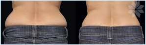 love handles before and after