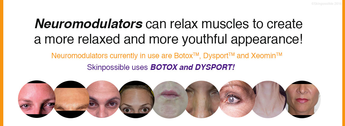 calgary botox dysport