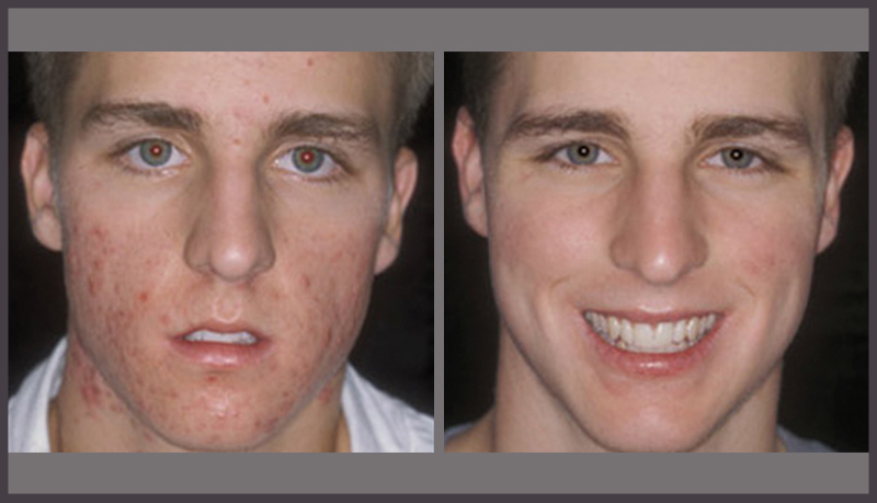 acne-treatment-for-men-in-calgary