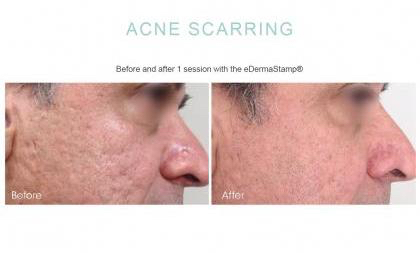 acne Scarring microneedling 3