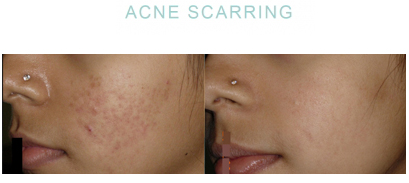 acne scar microneedling