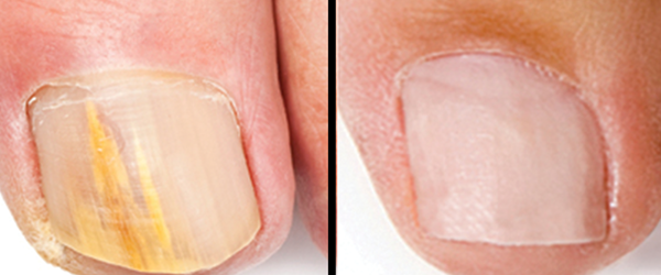 results from laser treatment of nail fungus calgary