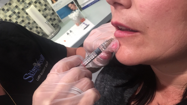 calgary-lip-injections-filler-skinpossible