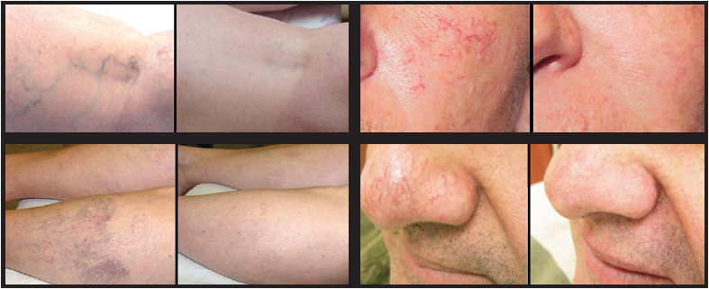 laser-vein-therapy-calgary-skinpossible
