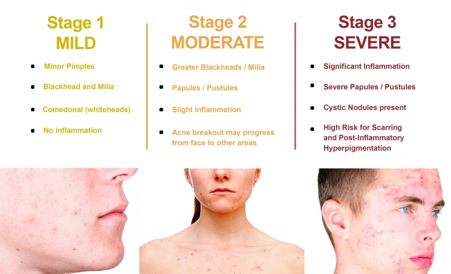 Acne, Scar and Pigment Treatments - Calgary - Zen Afterglow