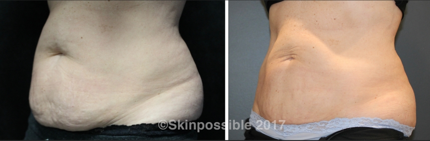coolsculpting-belly