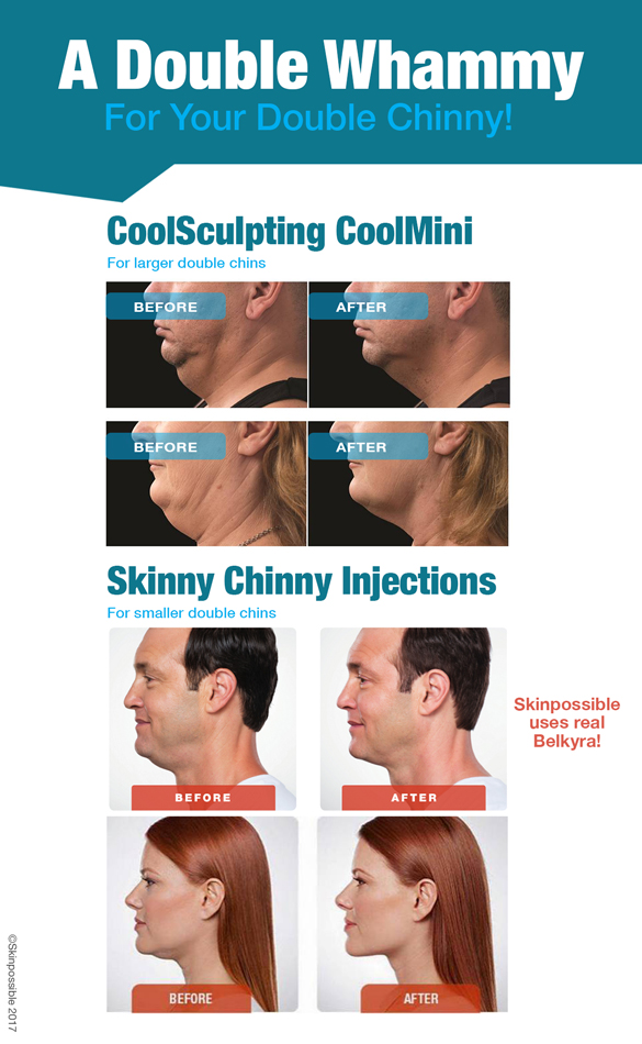 Double-chin-treatments