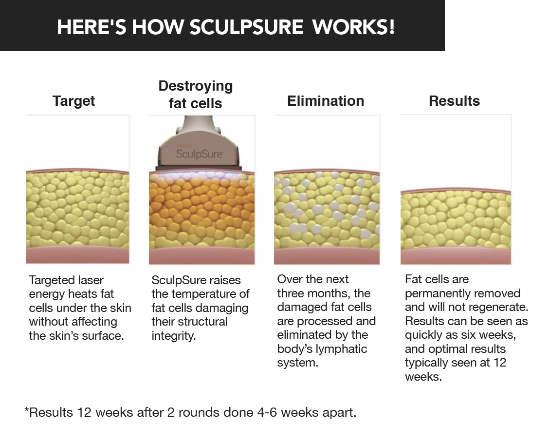 how does sculpsure work