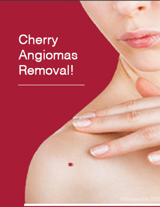 cherry angiomas removal