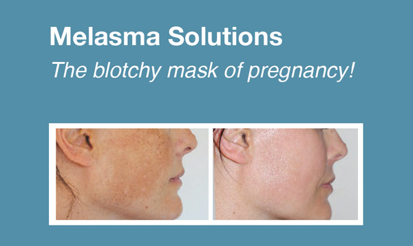 melasma pregnancy face patches