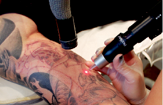 Laser tattoo removal 
