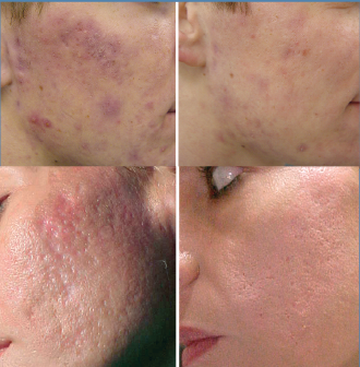 acne acne scars