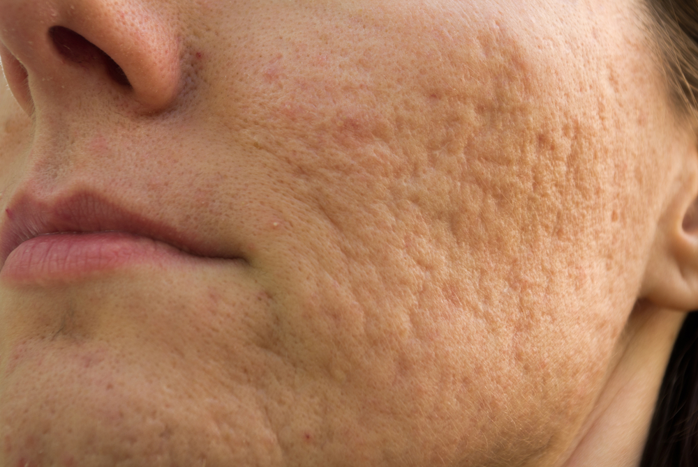 adult acne scarring treatment-calgary