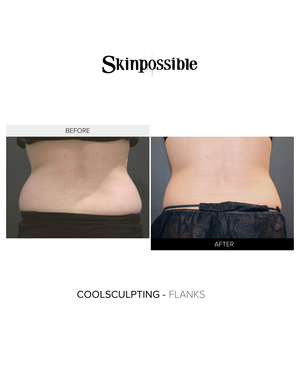 Coolsculpting results flanks