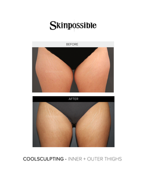 Coolsculpting thighs results